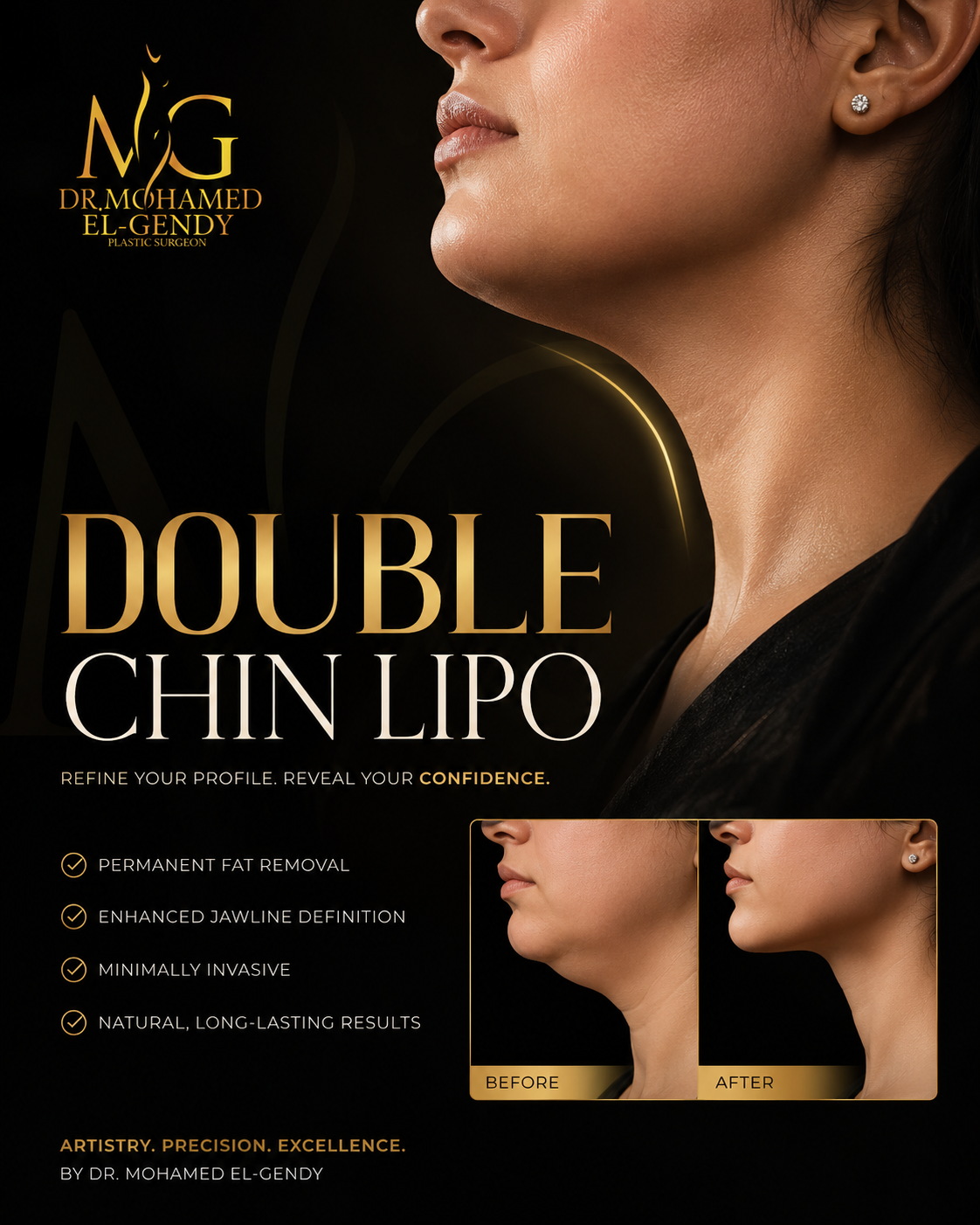 Double Chin Lipo service