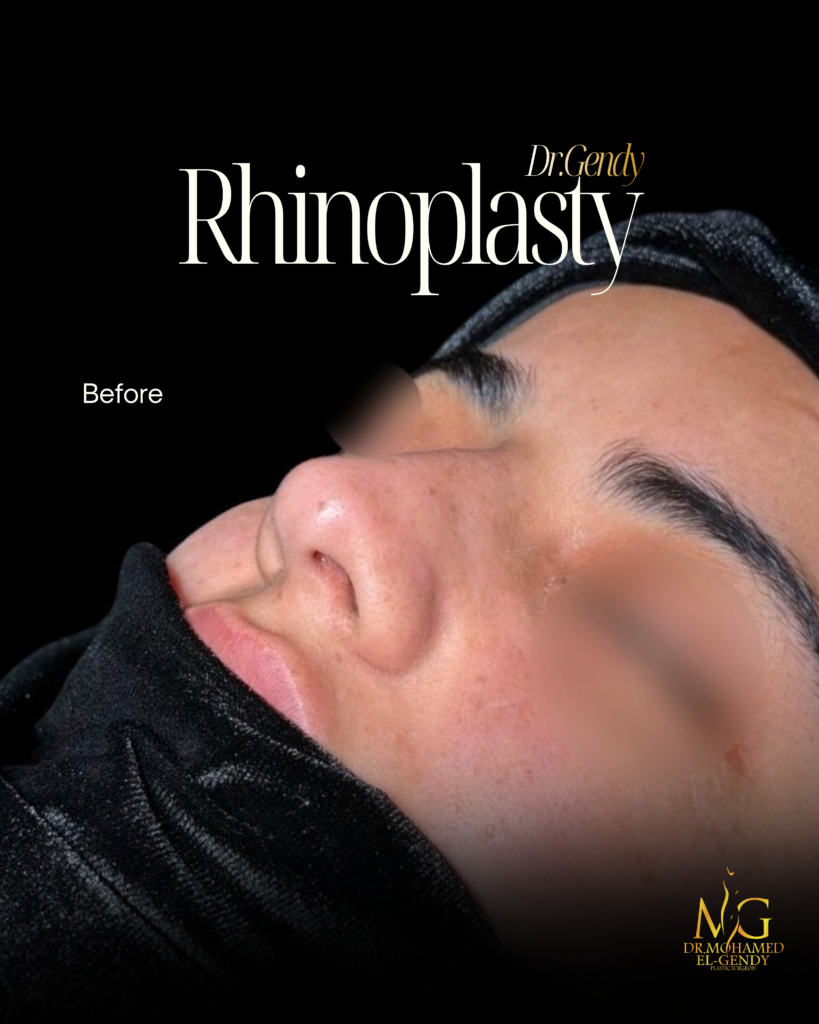 تجميل أنف - Before